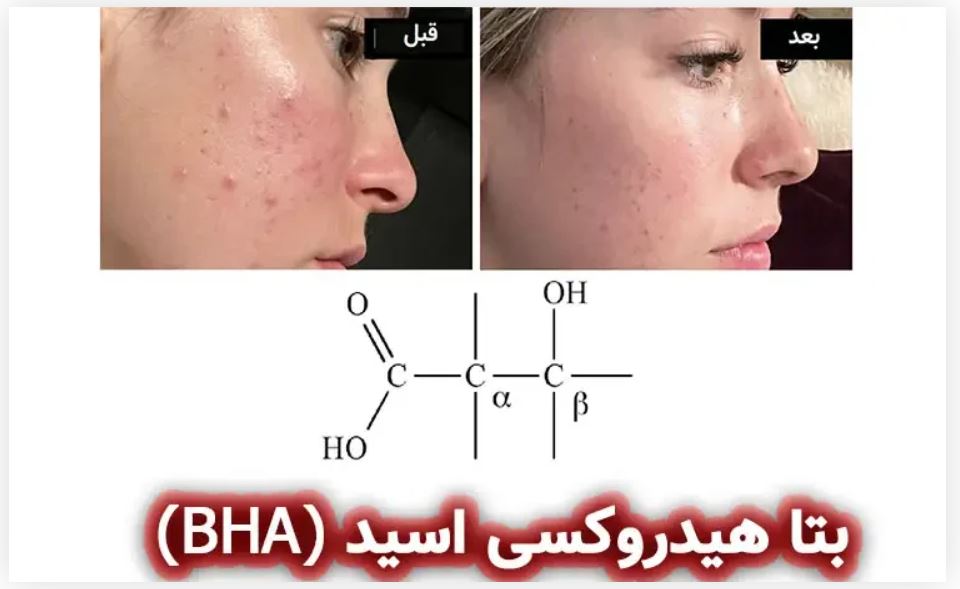 قبل و بعد از استفاده از بتاهیدورکسی اسید