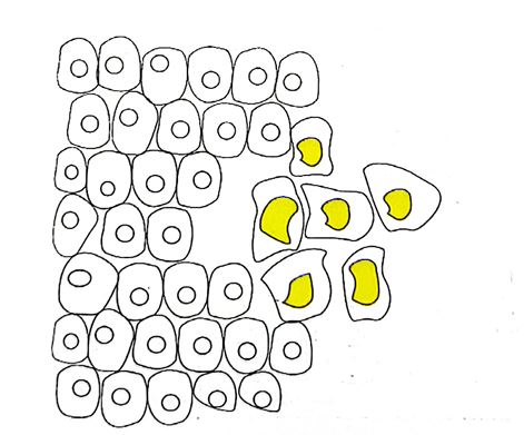گسترش موضعی یک تومور