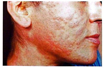 درماتیت تماسی آلرژیک 