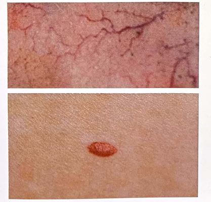 تلانژکتازی و آنژیوما